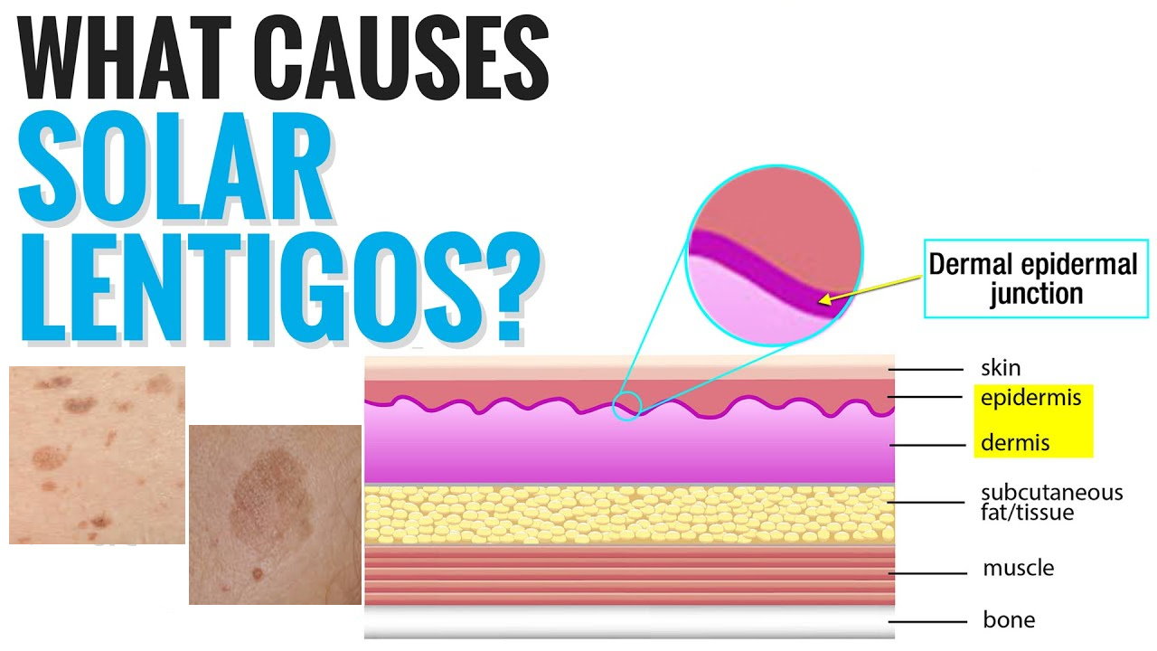 孚美达“氟轻松氢醌维A酸乳膏”能用于老年斑治疗吗？