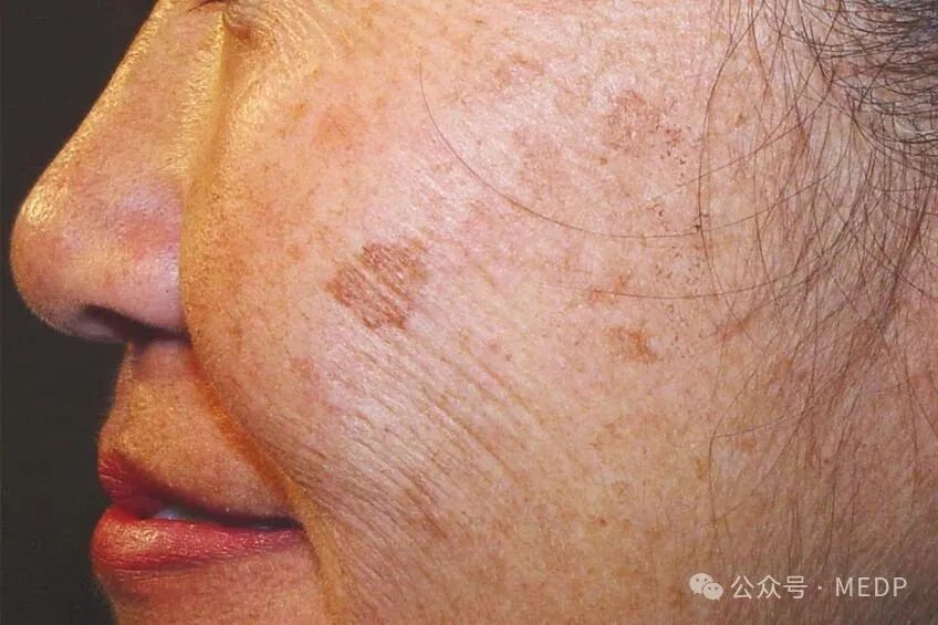 老年斑、晒斑、日光性雀斑是一回事吗？